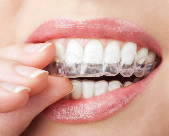 Kinh nghiệm cách giữ cho răng trắng đẹp không bị sâu răng -gacongnghe.com