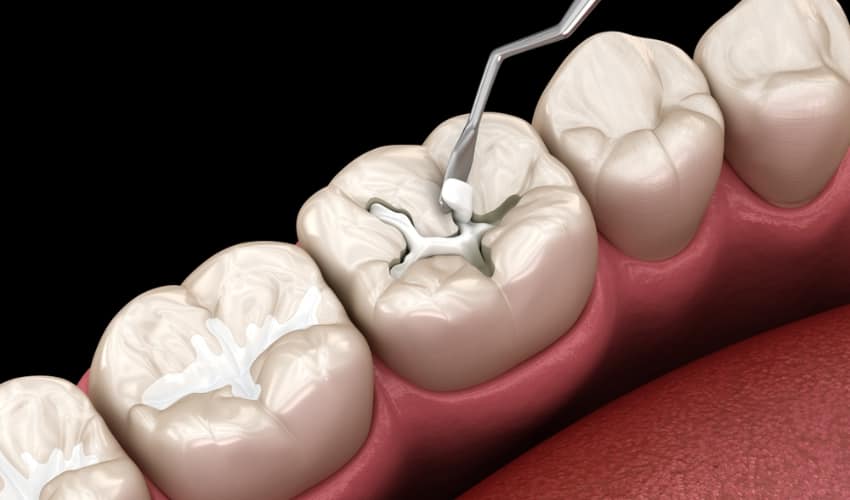 Kỹ thuật trám răng sử dụng vật liệu nhân tạo lấp vào mô răng bị thiếu