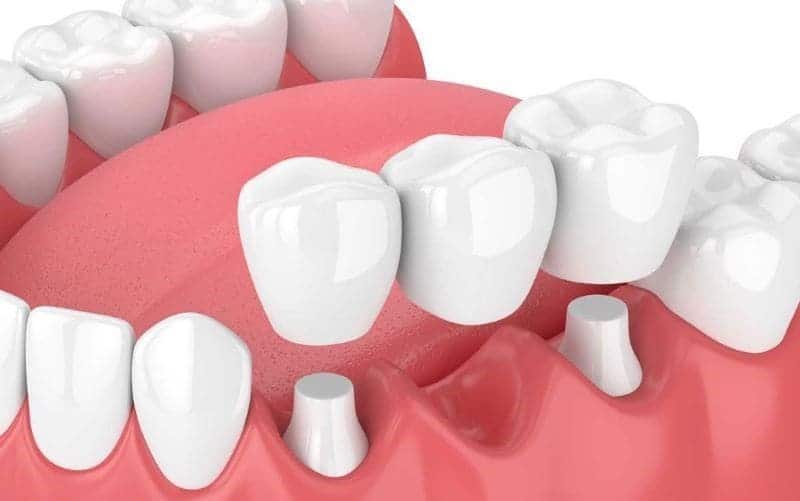 Cầu răng sứ truyền thống