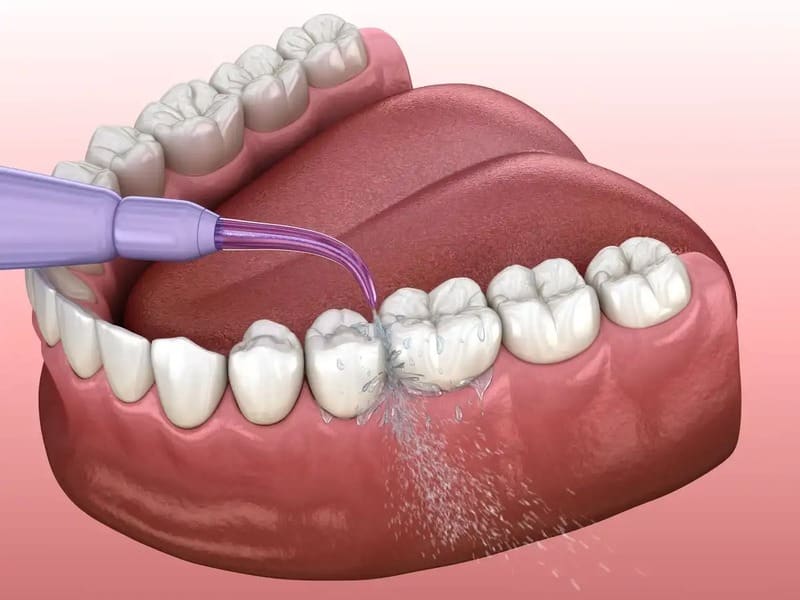 máy tăm nước làm sạch mảng bám trên răng