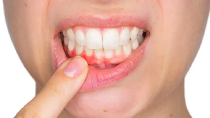  Viêm lợi là tình trạng phần lợi chân răng viêm nhiễm