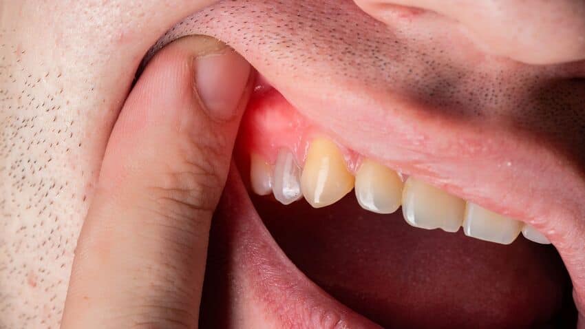 Nướu răng bị sưng ở bất kỳ vùng nướu nào trong khoang miệng