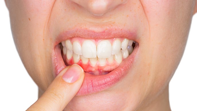 Sưng nướu răng do nhiều nguyên nhân khác nhau gây ra
