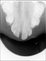 Occlusal