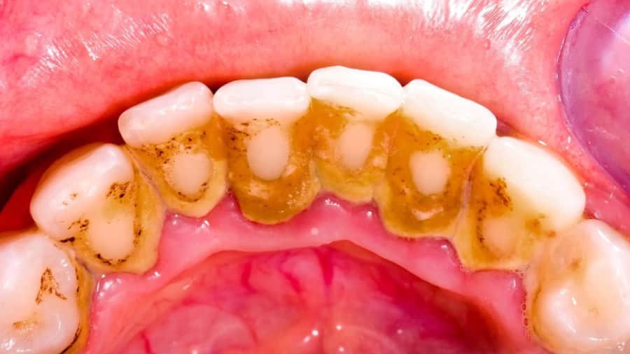 Nguyên nhân răng bị mảng bám đen