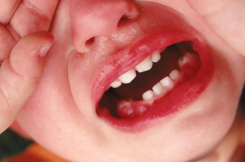 Trẻ em bị sưng chân răng hàm trên và dưới trong giai đoạn mọc răng