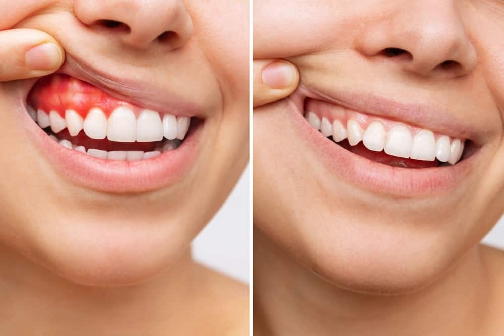 Bị sưng lợi nguyên nhân do đâu? Cách điều trị sưng lợi hiệu quả