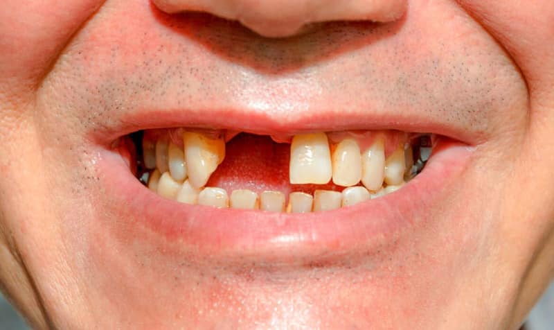 Răng bị gãy gây mất thẩm mỹ