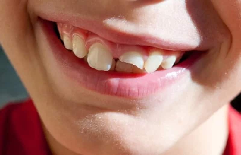  Trường hợp răng bị gãy đôi theo chiều ngang