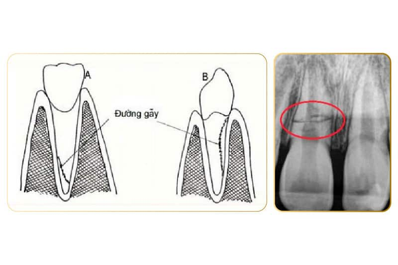 Trường hợp răng bị gãy chân răng