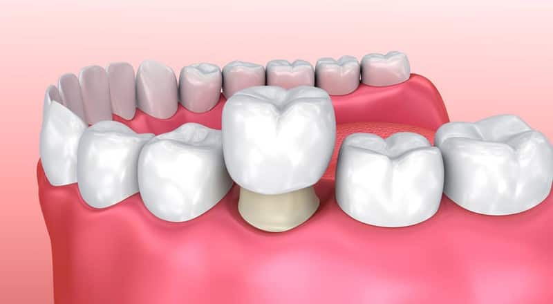 Bọc răng sứ điều trị gãy răng