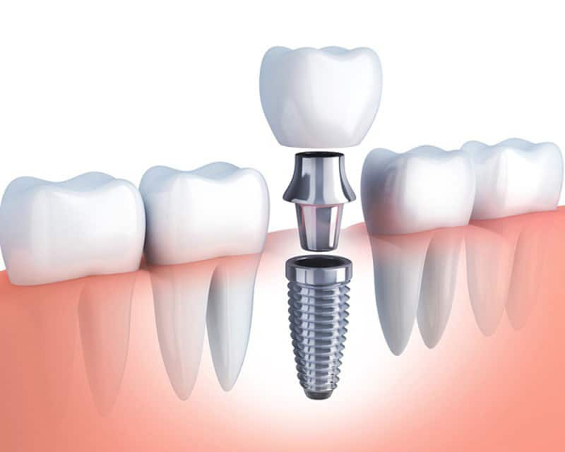 Trồng răng implant