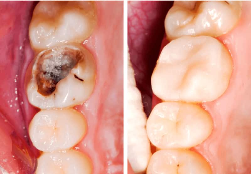 Trám răng là cách trị sâu răng phổ biến