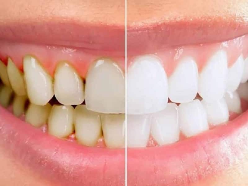 Lấy cao răng giúp bề mặt răng sạch sẽ, khiến răng có vẻ trắng hơn