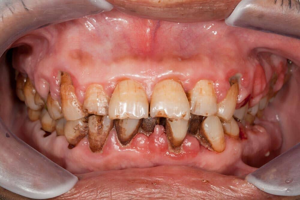 Cao răng đen là mảng bám đen dính trên răng