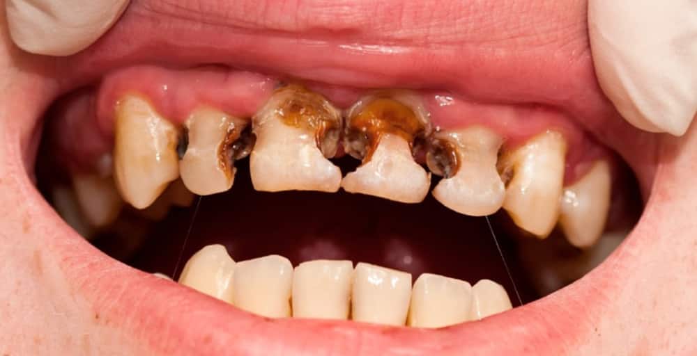 mảng bám đen trên răng xuất phát từ sâu răng