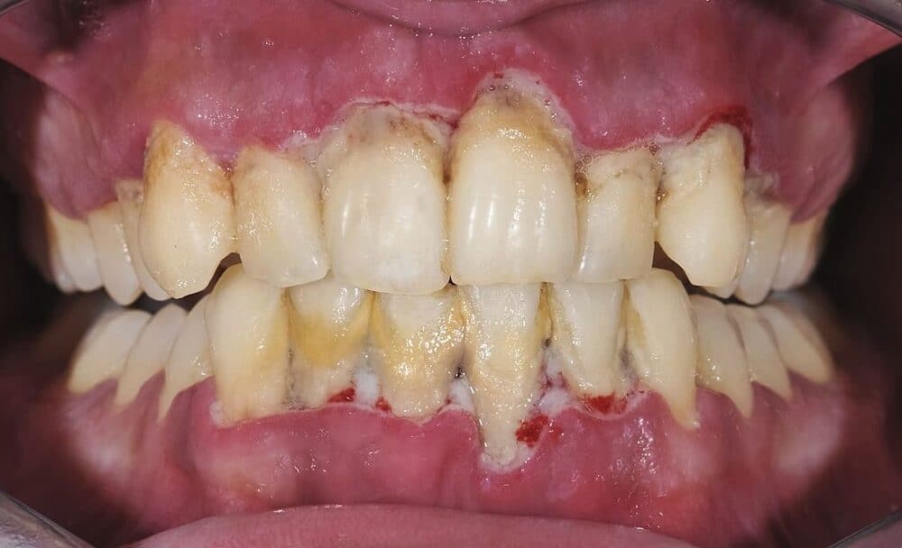 cao răng đen có thể gây ra viêm nha chu