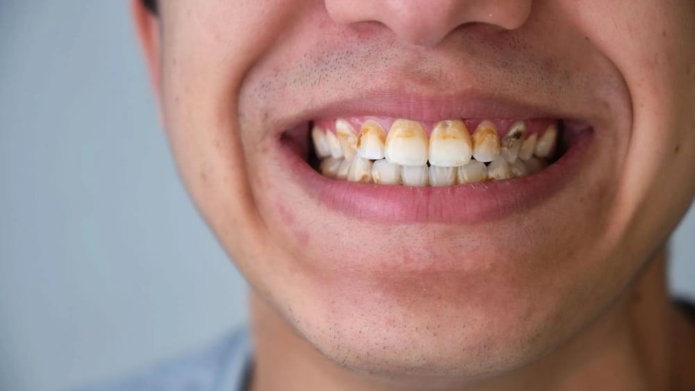 tẩy mảng bám đen trên răng tại nhà bằng chanh tẩy mảng bám đen trên răng tại nhà bằng chanh