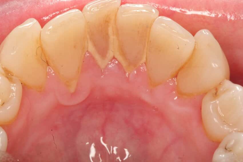 Cao răng hình thành từ sự tích tụ của chất cặn cứng của muối vô cơ và cặn mềm bám chặt vào bề mặt răng.