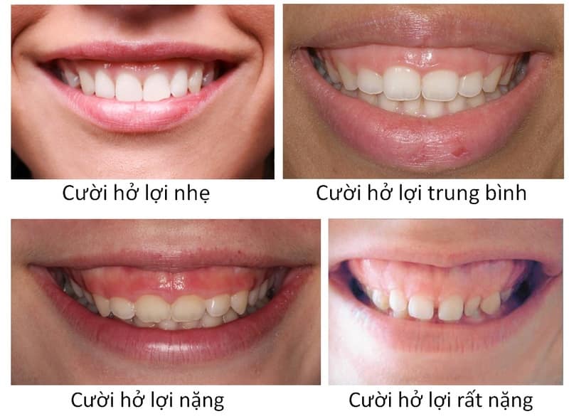 Phẫu thuật tạo hình nướu giúp cải thiện cười hở lợi, tụt lợi