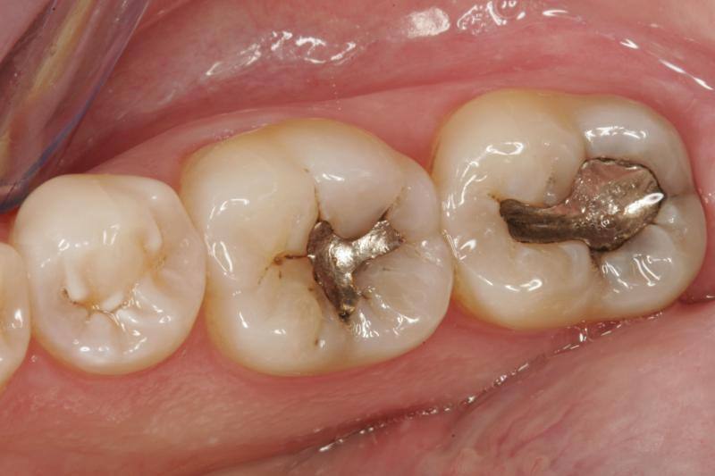 Hàn răng (trám răng) là thủ thuật nha khoa bịt kít mô răng