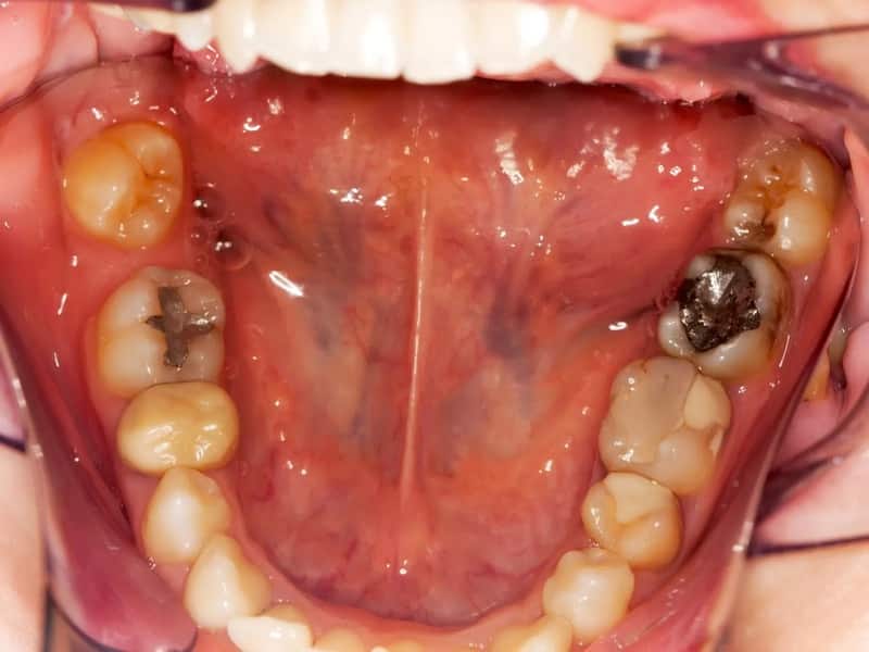 Hàn răng sâu không gây đau