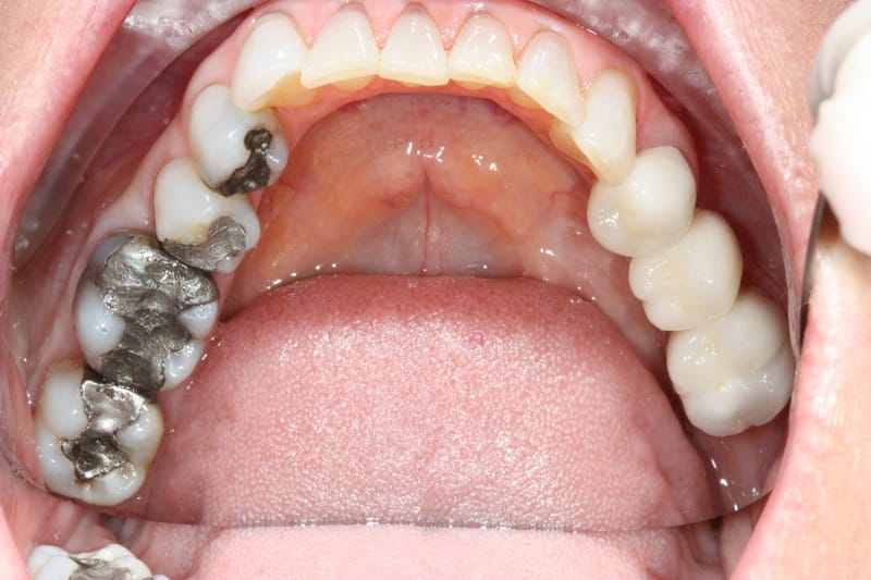 Nên hàn răng, trám răng sâu sớm nhất có thể
