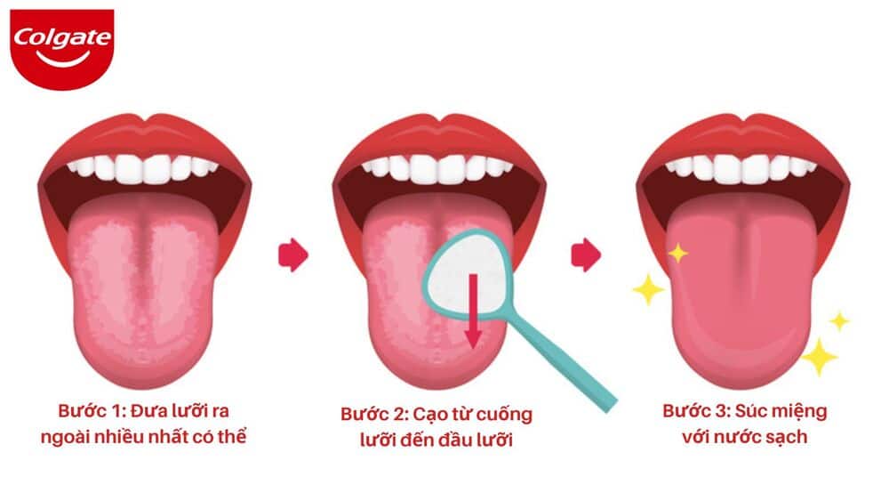 Cách vệ sinh lưỡi đúng cách theo 3 bước 