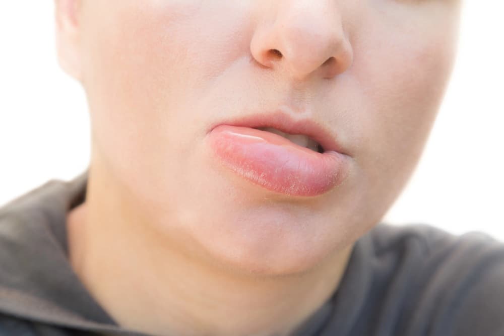 Sưng môi có thể là dấu hiệu của bệnh lý