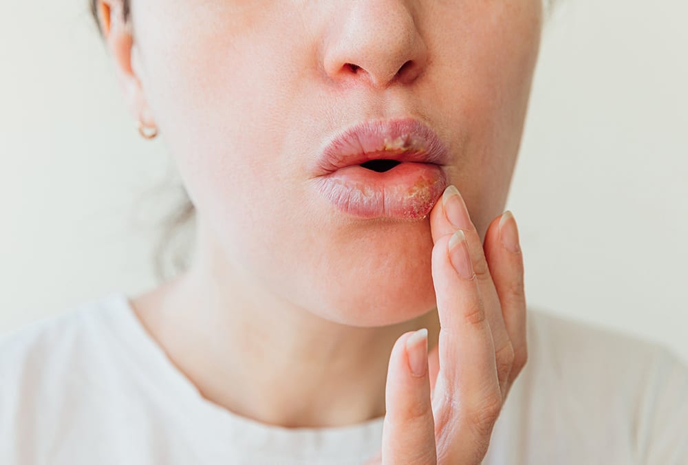 Vết loét là biến chứng nguy hiểm khi sưng môi
