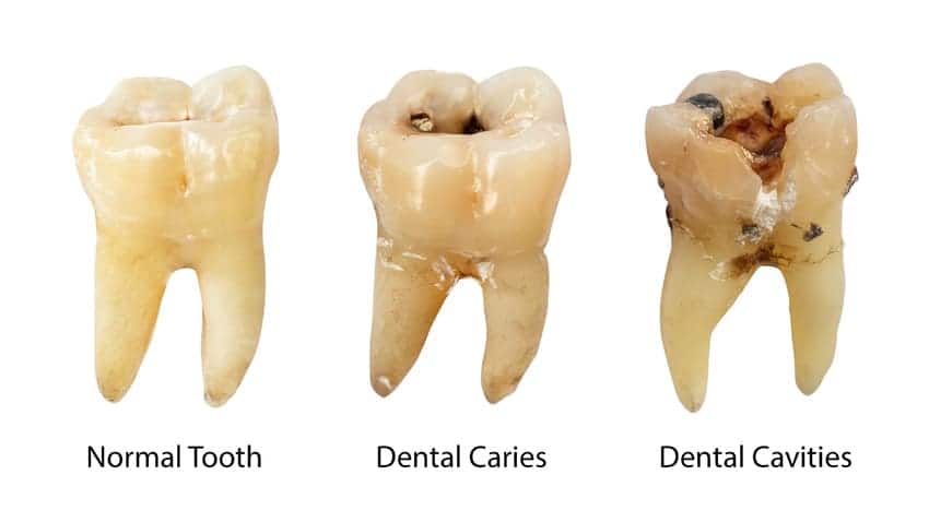 Dấu hiệu răng bị sâu