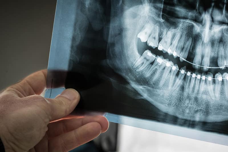 Người niềng răng sẽ được chỉ định chụp x-quang răng