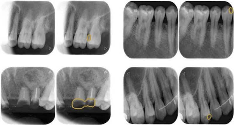 Chụp x quang răng để kiểm tra các răng bị sâu