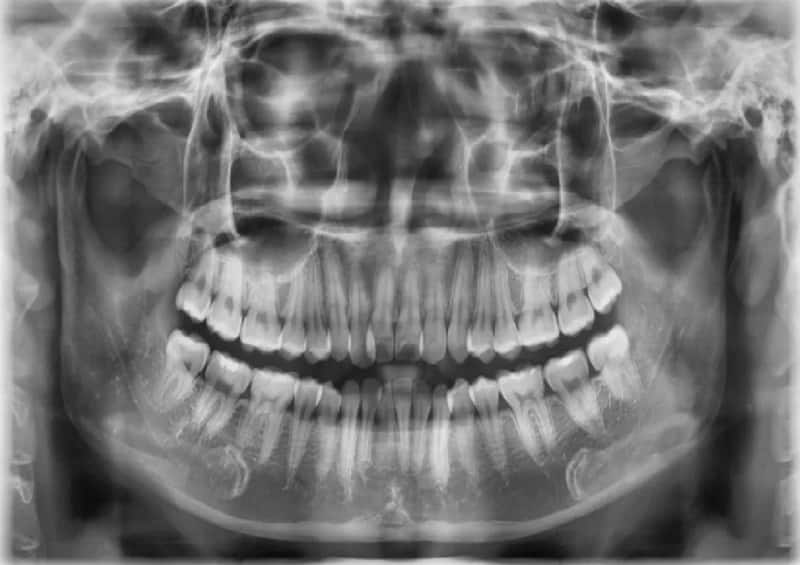 Hình ảnh chụp x quang răng nội nha