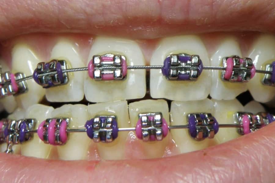 niềng răng là phương pháp thẩm mỹ chỉnh nha