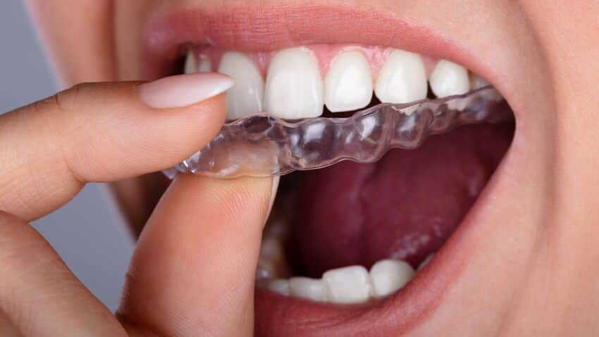 Dụng cụ bảo vệ răng theo khuôn răng