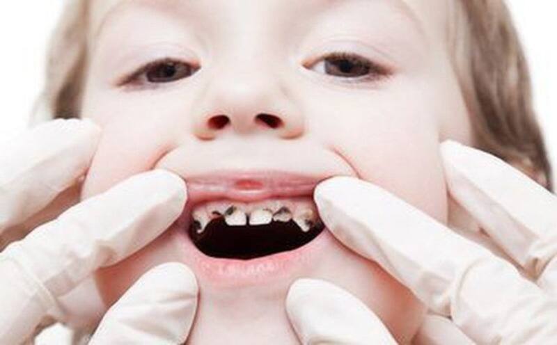 Tác hại của sâu răng trẻ em