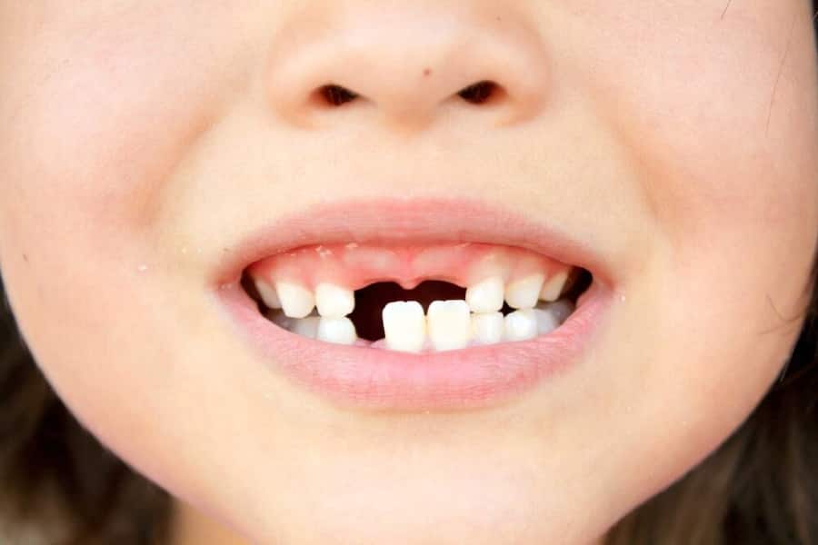 sâu răng ở trẻ em khiến gãy răng