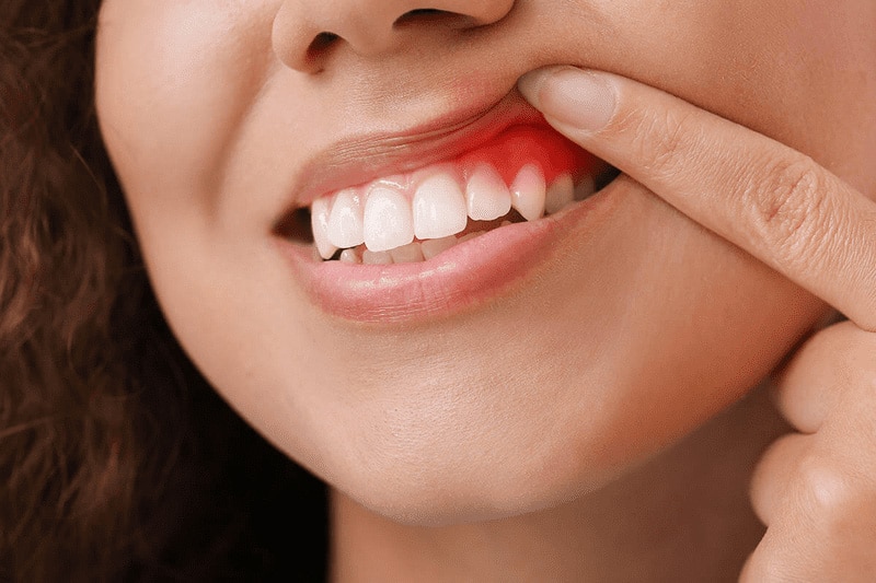 Có nhiều yếu tố làm tăng nguy cơ gây viêm lợi