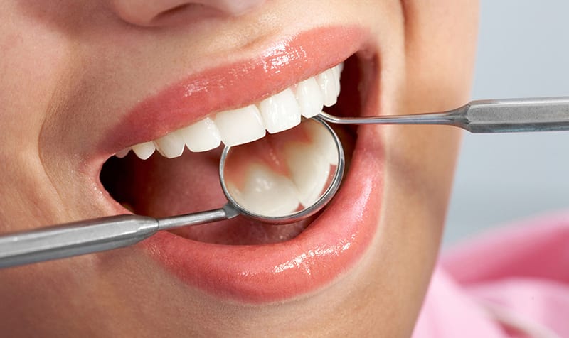 Trám răng là biện pháp phục hồi những chiếc răng bị tổn thương do sâu răng.