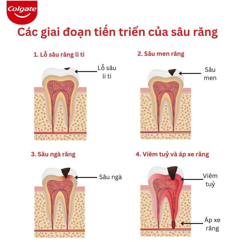 Các giai đoạn tiến triển của sâu răng