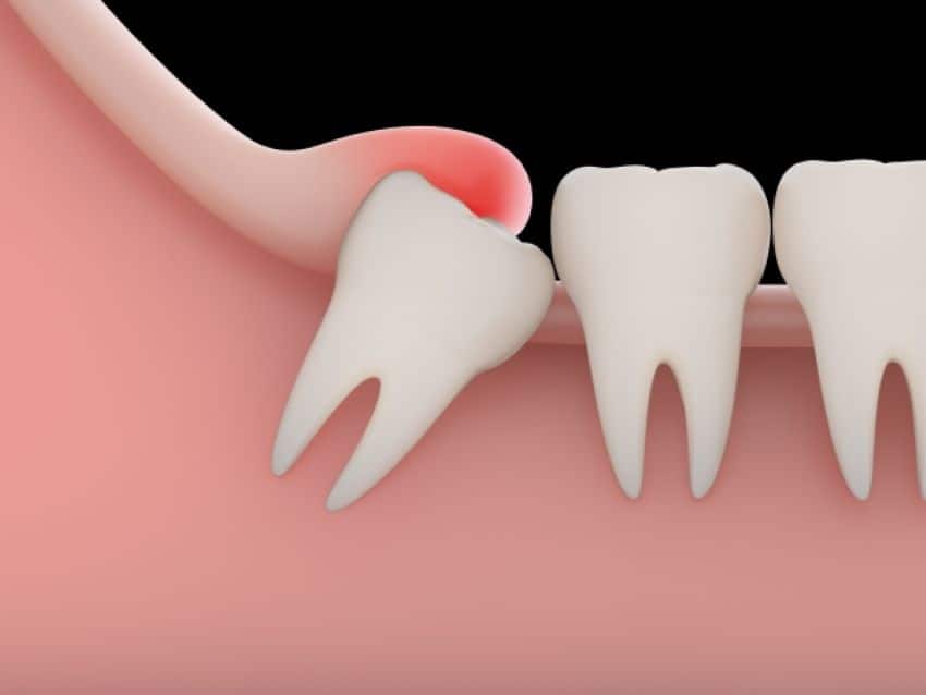 Mọc răng khôn có thể gây sưng lợi nếu răng mọc lệch hoặc vệ sinh không đúng cách