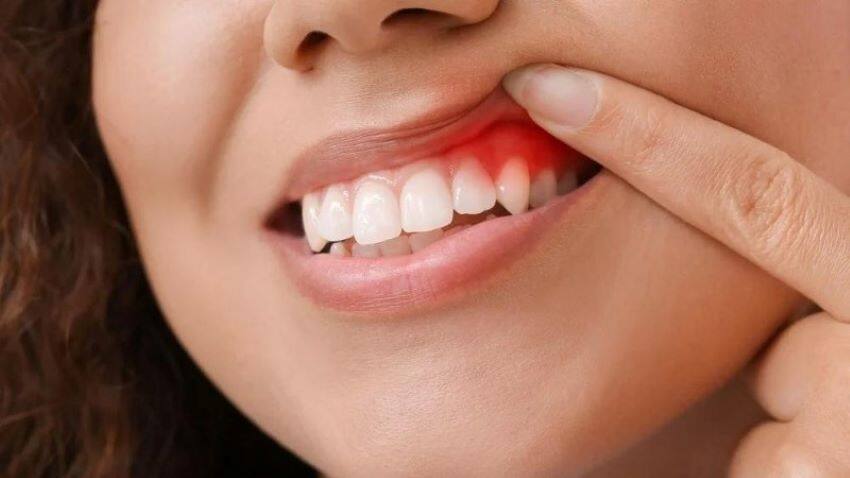 Sưng lợi gây nguy hiểm hay không phụ thuộc vào nguyên nhân và mức độ sưng cụ thể