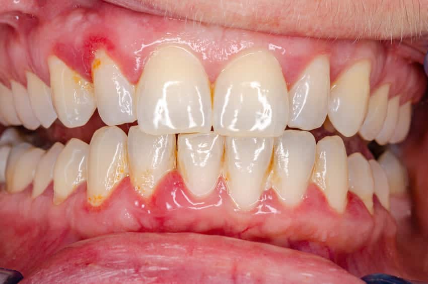 Hình ảnh viêm nướu răng và mảng bám quanh chân răng.