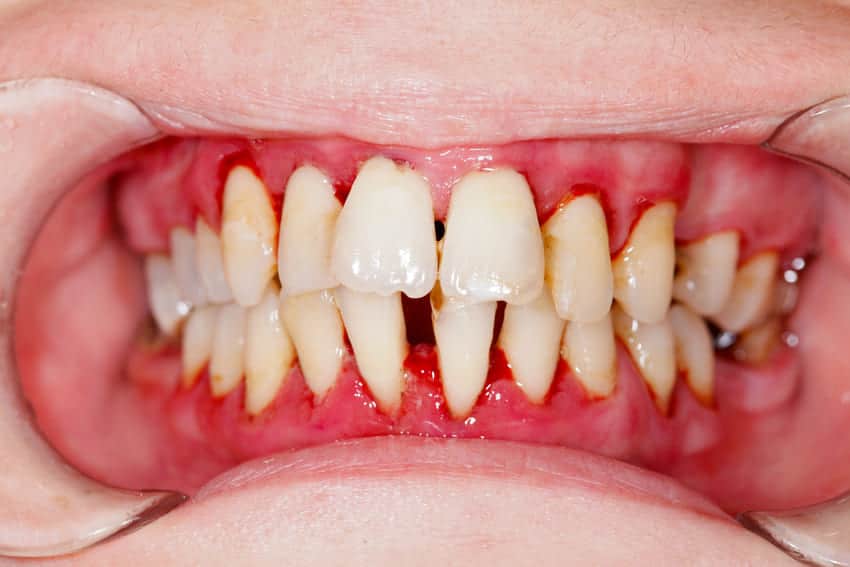 Hình ảnh viêm nướu răng mức độ nặng: nướu răng xốp, tụt nướu, và sắp dẫn tới mất răng.