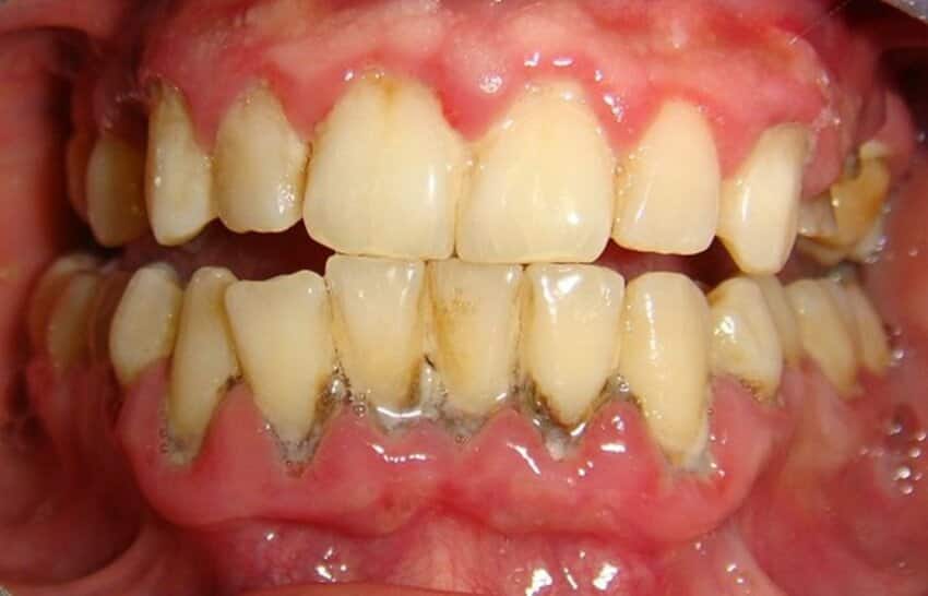 Cao răng dưới nướu có màu nâu hoặc đen và thường đi cùng tình trạng viêm nha chu.