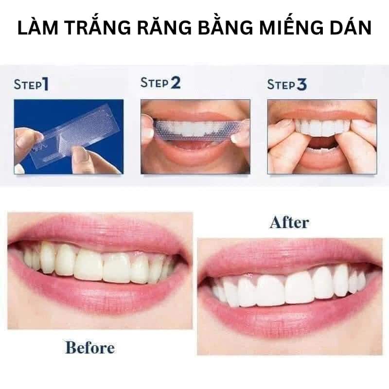 Trắng răng cấp tốc bằng miếng dán trắng răng 