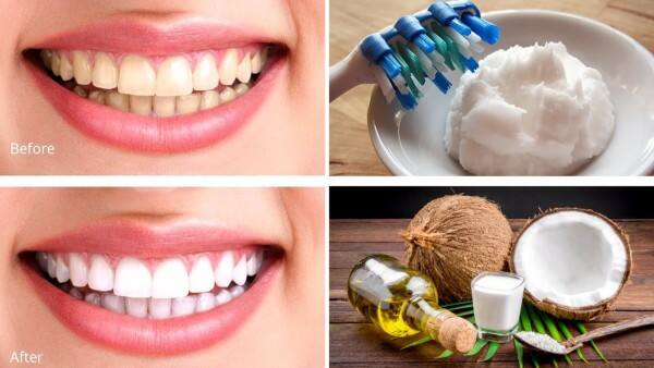 sử dụng dầu dừa làm trắng răng hiệu quả