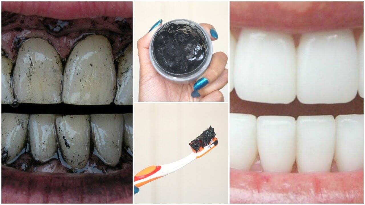 cách làm trắng răng tại nhà bằng than hoạt tính