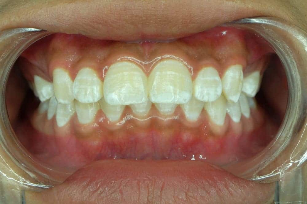 Men răng yếu do nhiều nguyên nhân t